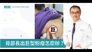 Epidermoid Cyst