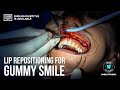 Lip Repositioning Surgery For Gummy Smile  (Case Study) - Narrated by Dr. Omer Karaaslan