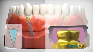 Ot Equator: Aditamento para Sobredentadura Retenida por Implantes