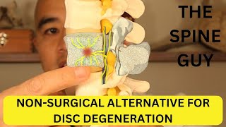 What is Basivertebral Nerve Ablation? A non-surgical alternative for Degenerative Disc Disease