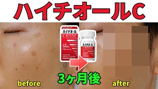 ハイチオールCでシミが消えるのか？3ヶ月飲み続けてみたら衝撃の結果に！(再UP)