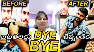 బట్టతల ఇకపై సమస్య కానే కాదు || Hair Patches For Men | Parmanent Hair Patch