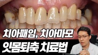 치아패임, 치아마모, 잇몸퇴축 치료법! 자세하게 꼬집어드립니다!