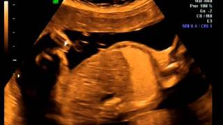 Ultrasound Month Five Week 23 סרט של פיצי 23  אולטרסאונד סקירת מערכות שבועות חודש חמישי.mpg