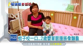 蚊子咬一口 　2歲嬰單眼腫脹像麵龜│三立新聞台