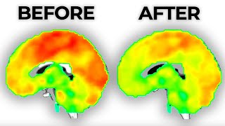 Long-term Effects of Antidepressants on the Brain