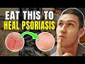 5 Foods to Eat if you Have Psoriasis | How to Treat Psoriasis