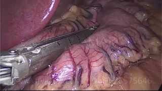 SLEEVE GASTRECTOMY (Laparoscopic, HD 1080p, Audio) - Dr. V. AMAR, www.drvamar.com