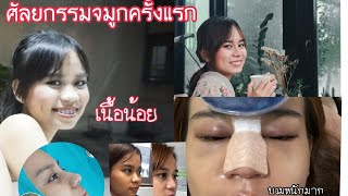 ประสบการณ์ทำจมูกเนื้อน้อย ครั้งแรก |ไม่เจ็บ แต่บวมหนักมาก