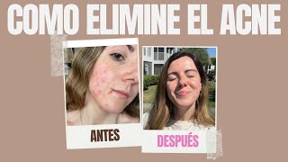 😱Como ELIMINÉ el ACNE después de 12 AÑOS: mi medico, productos y tratamiento✅