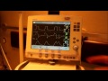 SPONTANEOUS BREATHING TRIAL: P01 AND RAPID SHALLOW BREATHING INDEX (RSBI) SERVO I MAQUET