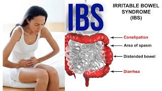 IBS symptoms | Irritable bowel syndrome symptoms | 5 Symptoms of IBS