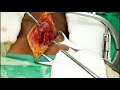 left thyroid lobectomy thyroid cancer operative surgery