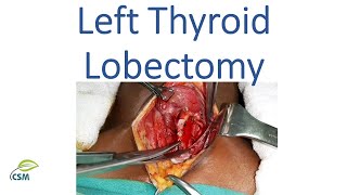 Left Thyroid Lobectomy - Thyroid Cancer - Operative Surgery