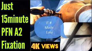 Proximal Femoral Nailing(PFN A2) Step By Step | Free Hand Distal Femoral Locking Surgical Technique.