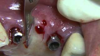 CV-77 Free Gingival Harvest and Uncovering of Two Anterior Implants... PREVIEW