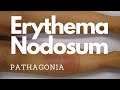 Erythema Nodosum: #pathagonia