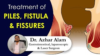 Treatment of Piles, Fissure and Fistula by Dr. Azhar Alam | পাইলস,  ফিশার,  ফিস্টুলা চিকিৎসা