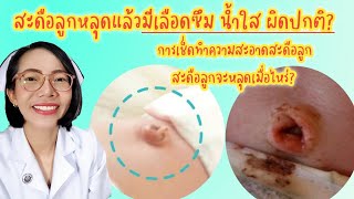 สะดือลูกหลุดแล้วมีเลือดซึมผิดปกติ? ทำความสะอาดยังไง|Nurse Kids