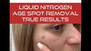 Liquid Nitrogen Treatment for Age Spots / Sun Spots / Dark Spots Removal Honest Review of Treatment
