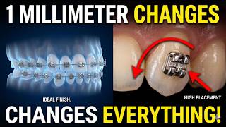Why Bracket Placement Changes Everything