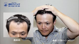 【植毛】生え際と前頭部に1800株を移植した40代体験者様の声をお届けします。　親和クリニック【 新宿・名古屋・大阪・福岡 】