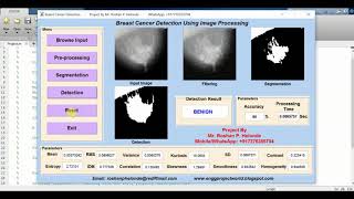 Matlab Code for Breast Cancer Detection Using Image Processing Full Source Code