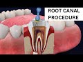 Root Canal Procedure Step by Step