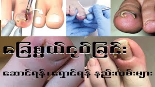 ခြေစွယ်ငုပ်ခြင်း (Ingrown Toenail)