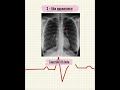 RADIOLOGICAL SIGNS IN CARDIOLOGY 🫀| CARDIOLOGY | CXR  #radiology  #viral  #shorts