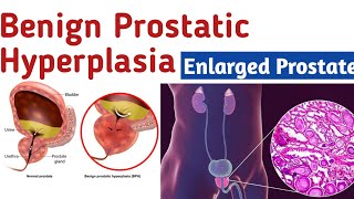 Benign Prostatic Hyperplasia - Enlarged prostate symptoms, what causes enlarged prostate, Diagnosis