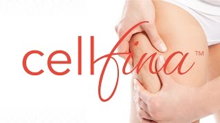 Cellfina for Long Term Cellulite Treatment