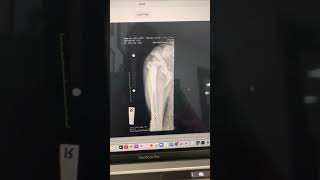 Some quick tips and tricks with pelvic radiographs and using calibration markers.