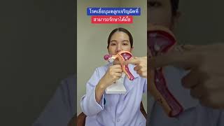 เยื่อบุมดลูกเจริญผิดที่ สามารถรักษาได้มั้ย?