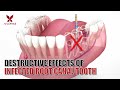 Destructive Effects of Infected Root Canal Tooth | Aria Dental | Maryam Horiyat DDS.