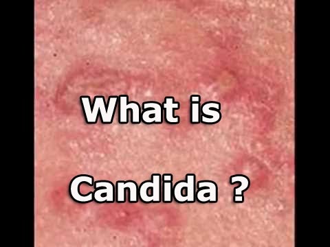 What Is Candida ? : Candida Overgrowth : Candida Die Off Symptoms - YouTube