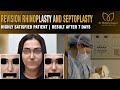 Revision Rhinoplasty and Septoplasty Result By Dr. Monisha Kapoor Delhi, India (Nose job)