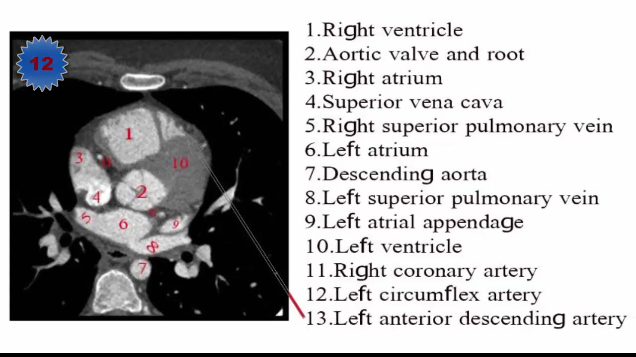Ct Cardiac Anatomy Oren Gottfried Md On X Ct Anatomy Heart And
