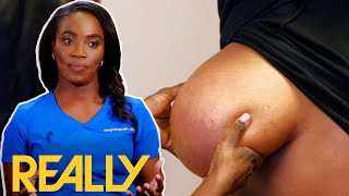 Dr. Mercy Odueyungbo Removes A 10 Year Old Gigantic Lipoma l Dr Mercy