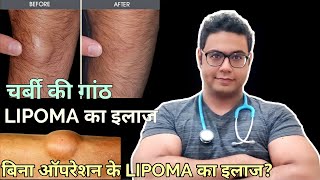 Doctor Explains: Lipoma ; Treatment without surgery and with surgery । LIPOMA का इलाज बिना ऑपरेशन के