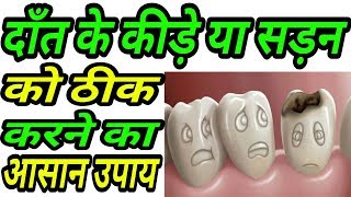 दाँतो के सड़न और कीड़े का आसान घरेलू नुस्खा | Daat Ke Sadan Ka Ghrelu Ilaj | Daant Me Kide Upay Hindi