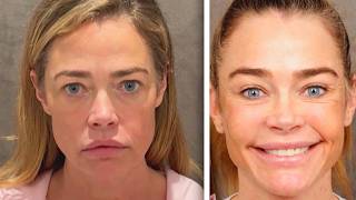 Denise Richards Undergoes Plastic Surgery By Dr. Ben Talei