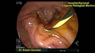 BASICS IN ERCP: Cannulation and stone extraction in a patient with large periampullary diverticulum