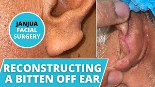 EAR RECONSTRUCTION ON MAN WHO GOT HIS EAR BIT OFF - DR. TANVEER JANJUA - NEW JERSEY