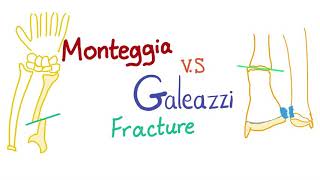 Monteggia Vs. Galeazzi fracture