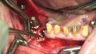 Short implants in a tropic lower posterior mandible