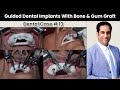 Guided Dental Implants Placement With Bone & Gum Graft | Dental Case # 13 | Dr. Shahzad Mirza