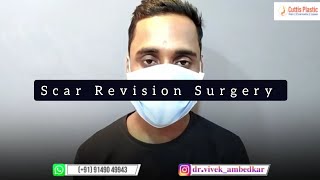 Scar Revision Surgery | Scar Removal Surgery | Face Scar | Old Scar