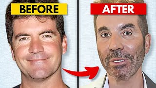 Why Is Simon Cowell's Face Melting? His Plastic Surgery NIGHTMARE