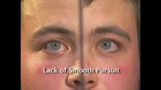 HGN Test | Horizontal gaze nystagmus | HGN | Nystagmus Test | Horizontal gaze nystagmus test